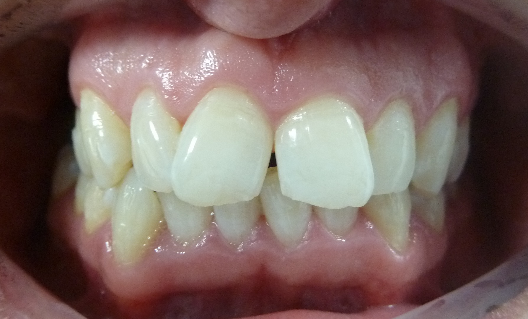 before invisalign afters braces treatment birmingham